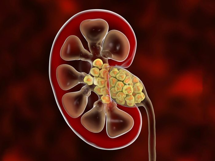 Mayo clinic online tool kidney stones