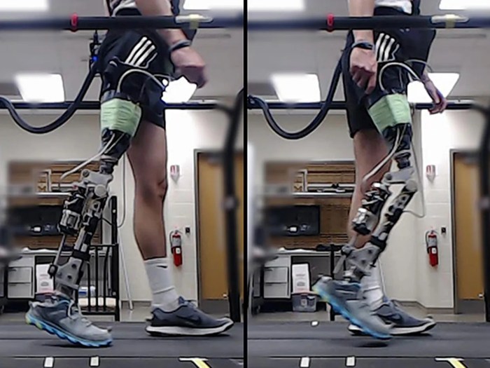 Prosthetic legs tuned using ai help walk faster